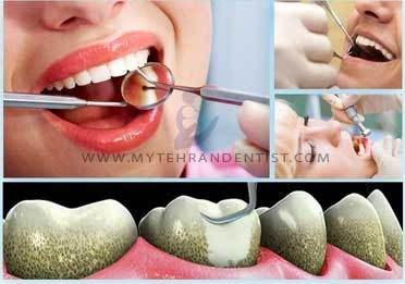 آیا جرمگیری دندان  به دندان آسیب میرساند ؟