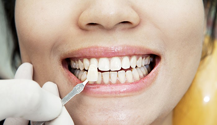 How are dental lumineers applied to the teeth