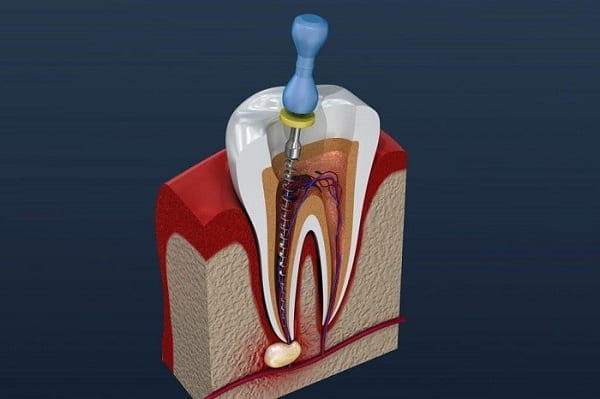 Benefits of Root Canal Treatment in Tehran
