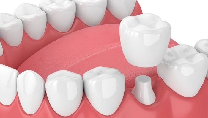 DENTAL CROWNS