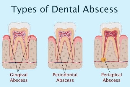 Understanding How and Why Abscesses Form