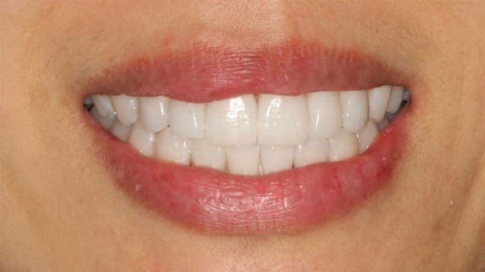 The Benefits of Traditional and No Shaving Veneers