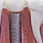 Dental crown vs. dental implant