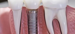 Dental crown vs. dental implant