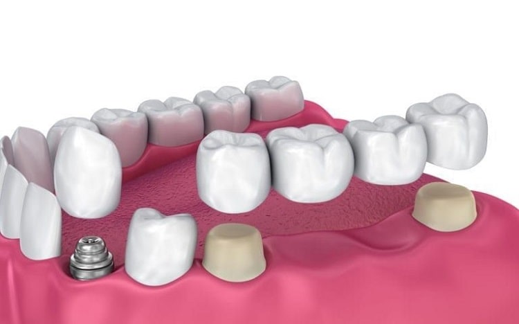 dental implant center in Dwarka Helps You Achieve Your Dreams