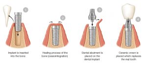 What happens during my dental implant procedure?